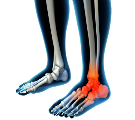 Stress Fractures - Alabama Bone and Joint Clinic